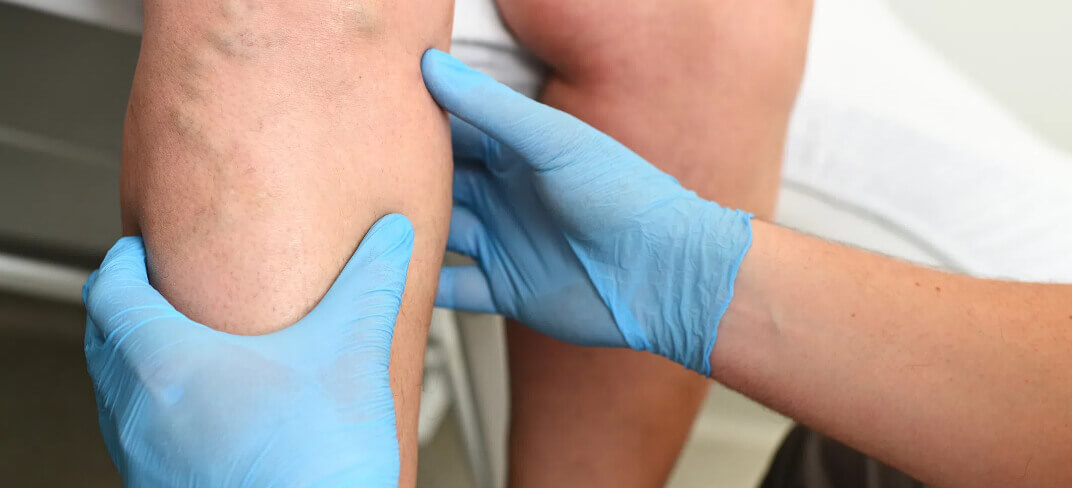 Varicose Veins: Symptoms and Treatments | UPMC Italy