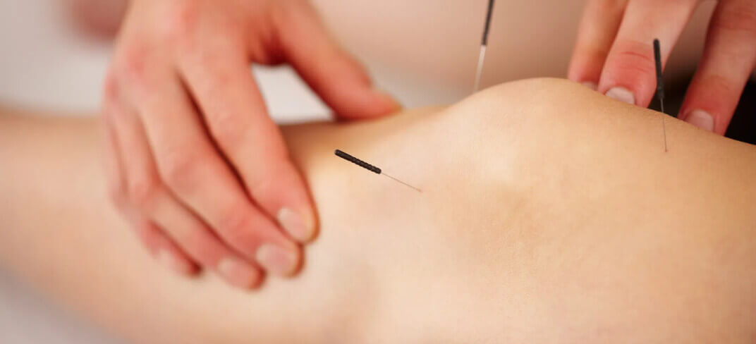 6 Domande Frequenti sull’Agopuntura | UPMC Italy