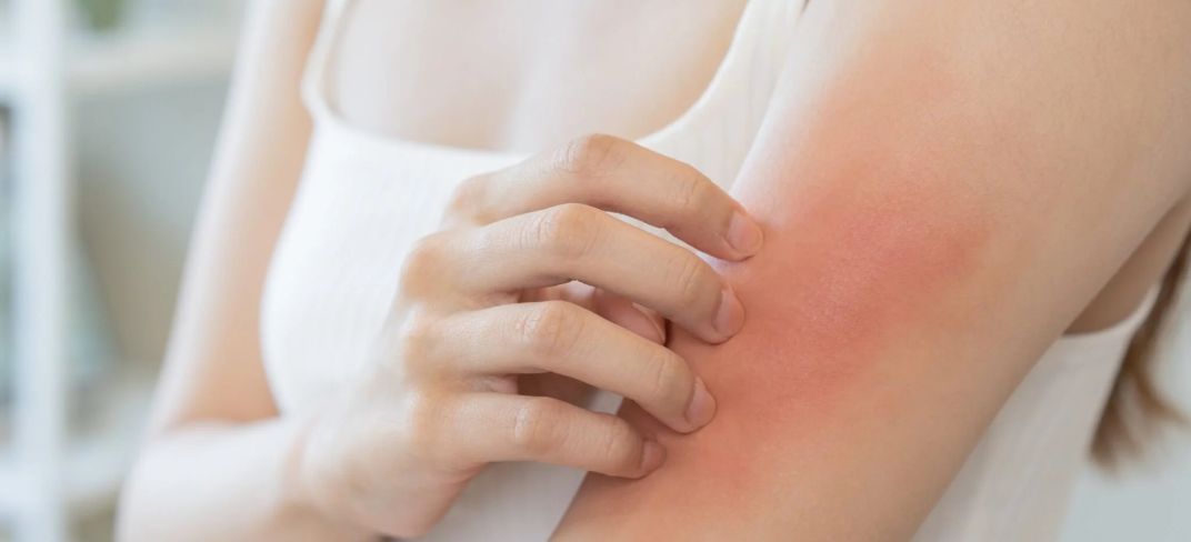 Why Scratching a Skin Irritation Can Make It Worse | UPMC Italy