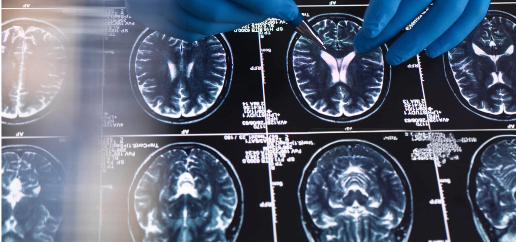 The Brain’s Body Map Remains Intact After Amputation | UPMC Italy